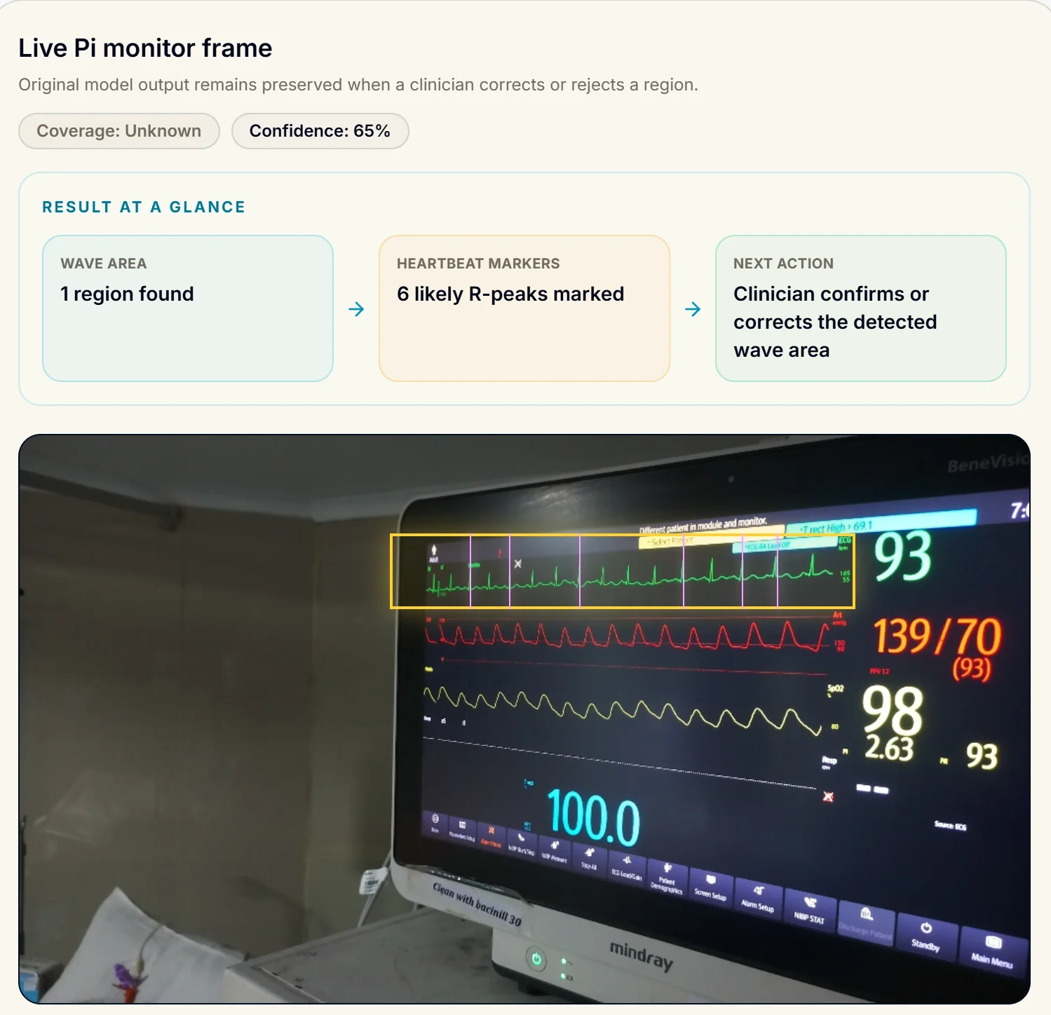 ASTA ECG waveform workbench: a bedside camera photo of a Mindray patient monitor with a yellow detection box drawn around the ECG strip, R-peak markers, and a result strip reading one region found, six likely R-peaks marked, clinician confirms or corrects.